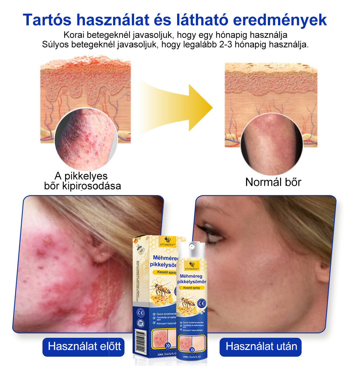 (đ„ 60% kedvezmĂ©ny az utolsĂł napi csomag vĂĄsĂĄrlĂĄsĂĄhoz đ„) VitaNovaâą PsoriaHeal psoriasis Spray prođ„GlobĂĄlis szĂĄllĂtĂĄs