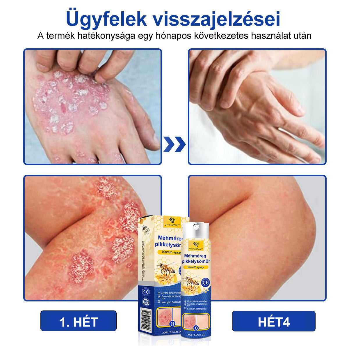 (đ„ 60% kedvezmĂ©ny az utolsĂł napi csomag vĂĄsĂĄrlĂĄsĂĄhoz đ„) VitaNovaâą PsoriaHeal psoriasis Spray prođ„GlobĂĄlis szĂĄllĂtĂĄs