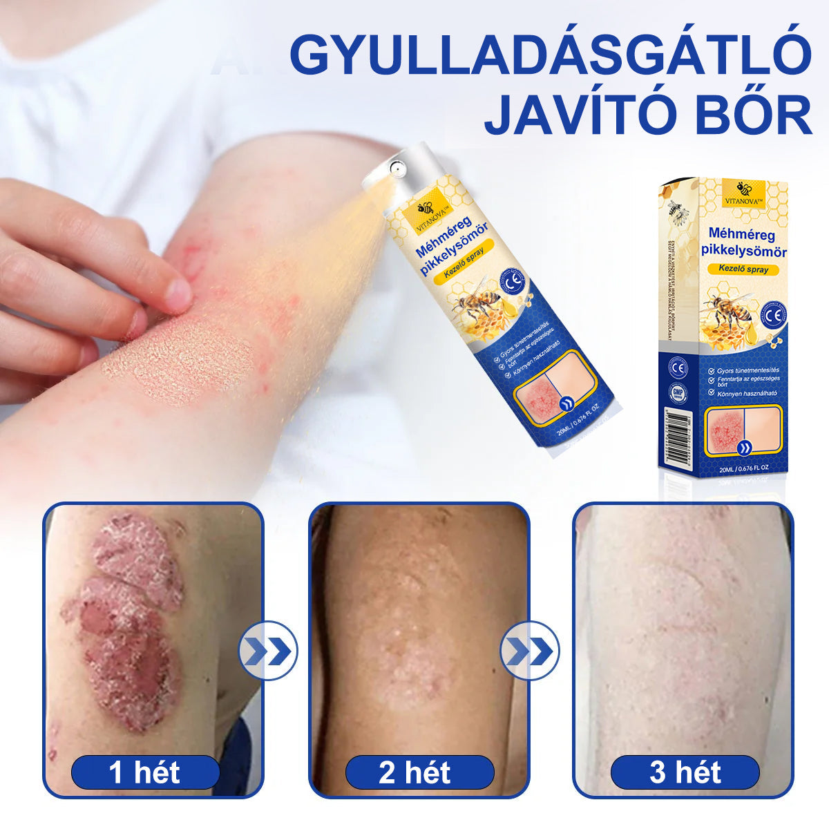 (đ„ 60% kedvezmĂ©ny az utolsĂł napi csomag vĂĄsĂĄrlĂĄsĂĄhoz đ„) VitaNovaâą PsoriaHeal psoriasis Spray prođ„GlobĂĄlis szĂĄllĂtĂĄs