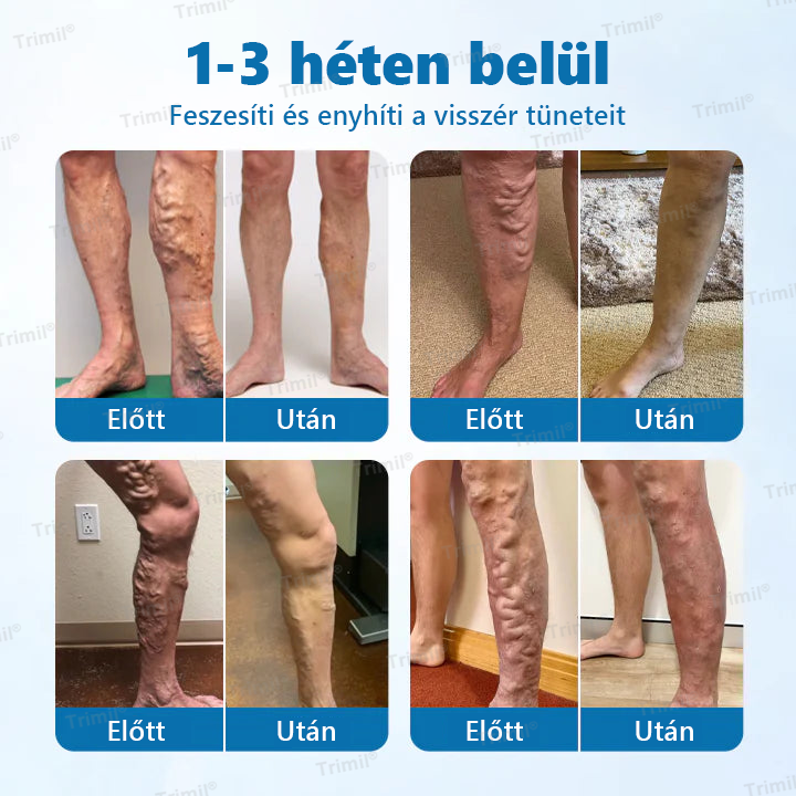 💚💚Trimil® VeinGuard Gyógynövényes Spray - ✅ Klinikailag bizonyított, hogy mindössze 7 nap alatt megszünteti a visszereket!💚💚