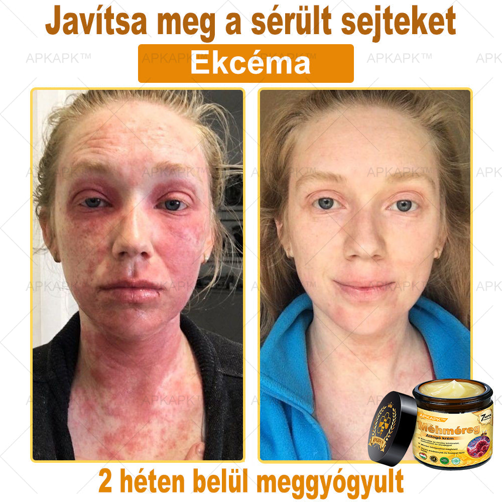 𝐀𝐏𝐊𝐀𝐏𝐊™ 𝐌É𝐇𝐌É𝐑𝐄𝐆 Á𝐓𝐅𝐎𝐆Ó 𝐊𝐑É𝐌🥇🥇𝐀 𝐛ö𝐫𝐩𝐫𝐨𝐛𝐥é𝐦á𝐤 𝐤𝐞𝐳𝐞𝐥é𝐬𝐞 𝐦𝐚𝐠á𝐛𝐚𝐧 𝐟𝐨𝐠𝐥𝐚𝐥𝐣𝐚: é𝐥𝐞𝐭𝐤𝐨𝐫𝐢 𝐟𝐨𝐥𝐭𝐨𝐤, 𝐡𝐞𝐠𝐞𝐤, 𝐬𝐳𝐞𝐦ö𝐥𝐜𝐬ö𝐤, 𝐛ö𝐫𝐧ö𝐯𝐞𝐝é𝐤𝐞𝐤, 𝐭á𝐥𝐲𝐨𝐠𝐨𝐤, 𝐩𝐚𝐭𝐭𝐚𝐧á𝐬𝐨𝐤, 𝐞𝐤𝐜é𝐦𝐚, 𝐩𝐬𝐨𝐫𝐢𝐚𝐬𝐢𝐬, 𝐚𝐜𝐧𝐞 𝐢𝐧𝐯𝐞𝐫𝐬𝐚, 𝐫á𝐧𝐜𝐨𝐤, 𝐛ö𝐫ö𝐫𝐞𝐠𝐞𝐝é𝐬 é𝐬 𝐞𝐠𝐲é𝐛 𝐩𝐫𝐨𝐛𝐥é𝐦á𝐤🔥