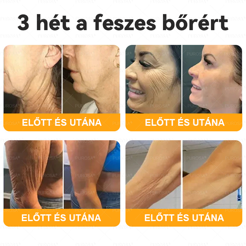 🐝🌿PUROSA® Méhméreg Bőrfelújító Krém 🔥 UTOLSÓ NAP – 80% KEDVEZMÉNY🔥